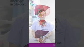 How Does PTBD Differ from ERCP in Accessing Bile Ducts  Dr praveen Kammar Mumbai [upl. by Anrym397]