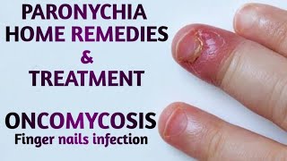 Paronychia Home remedies  Finger nail infection  skin infections  paronychia  finger infection [upl. by Soisatsana]