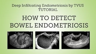 Deep Infiltrating Bowel Endometriosis Detection by TVUS Tutorial [upl. by Wilkie304]