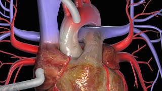 Heart Bypass Surgery CABG [upl. by Malone]