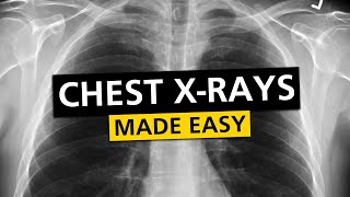 Chest X Rays CXR Made Easy  Learn in 10 Minutes [upl. by Temhem]