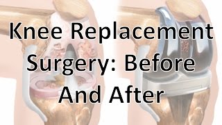 Knee Replacement Surgery Before And After [upl. by Ruomyes]