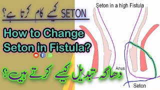 How to change Seton in Fistula in Ano  Surgeon Dr Imtiaz Hussain [upl. by Colp687]