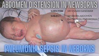 Abdominal Distension In Neonates  Pneumonia In Neonates  Sepsis In Newborn  Neonates In NICU [upl. by Padraic]