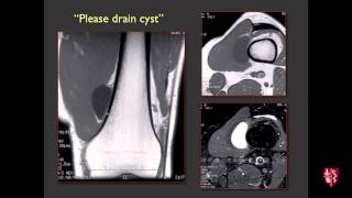 Interventional Radiology for Sports Medicine  Innovations in Ultrasound Guided Therapy [upl. by Rozele]