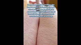 what is dermatographia ytshorts knowledge youtubeshorts [upl. by Ydnil]