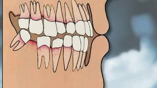 Dental Implants Pros amp Cons  YOU MUST SEE IT [upl. by Ahsiekyt]