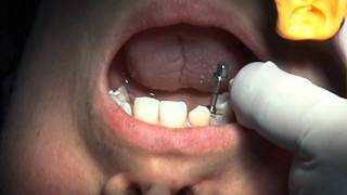 Perform the Ultimate Atraumatic Extractin with the Easy X Trac System [upl. by Einttirb]