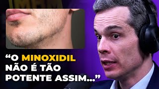 ESPECIALISTA revela A VERDADE sobre o MINOXIDIL [upl. by Emelen358]