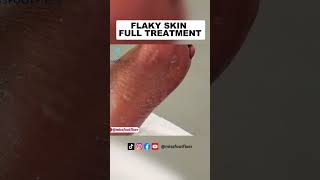 Flaky Skin full Treatment by Miss Foot Fixer [upl. by Hartnett]