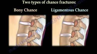 Chance Fractures of the Spine  Everything You Need To Know  Dr Nabil Ebraheim [upl. by Huston]