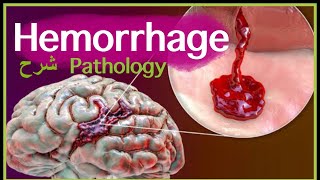 Pathology  Hemorrhage  Blood Hemodynamic disorders شرح باثو [upl. by Adnamma547]