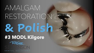 Amalgam Restoration and Polish 3 MOL Kilgore [upl. by Ahsel]