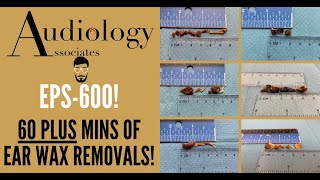 60  MINUTES OF EAR WAX REMOVALS  EP600 [upl. by Kingsley273]