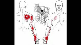 Active Release Technique of Rhomboids Muscle [upl. by Syman]