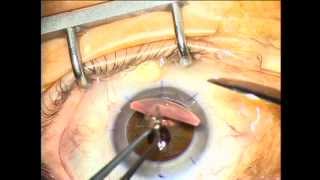 Trapianto cheratoplastica perforante più cataratta  Cornea transplant with cataract surgery [upl. by Enelrahs]