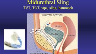 Stress Urinary Incontinence Evaluation and Treatment [upl. by Boucher]