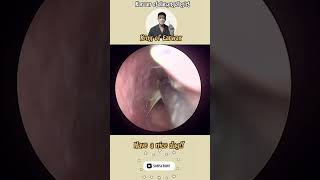 귀지형 콧물 부비동염 축농증 비염 코청소 이비인후과 rhinorrhea rhinitis sinusitis asmr ENT entdoctor [upl. by Bremen]