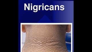 Acanthosis Nigricans [upl. by Jaclin]