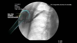 Video de Fluoroscopía del Húmero Proximal Humano con el Sistema Arrow® EZIO® [upl. by Trudie]