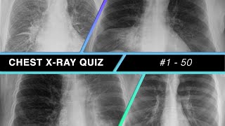 Chest Xray Quiz 1  50 [upl. by Aynik]