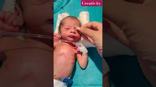 Eye Infection Of Newborn And Care cutebaby nicu newbornbaby [upl. by Adliw935]