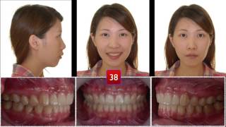 Correction of Skeletal Class ll Malocclusion｜【Chris Chang Ortho】CC423 [upl. by Ikcin]