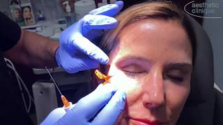 Demonstration Of Cannula Injection Of Cheek With Restylane Lyft [upl. by Williams]