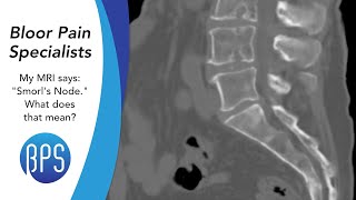 My MRI Says quotSchmorls Nodequot What Does That Mean  Common MRI Questions ANSWERED [upl. by Adnimra]