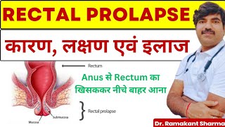 Rectal Prolapse  Symptoms Causes and Treatment  Dr Ramakant Sharma [upl. by Nyra39]