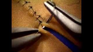 Basic Microsuture Technique [upl. by Eiroj]