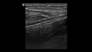 Gastrocnemius Tear  QMH AED Ultrasound Casebook 201205 [upl. by Leahcin]