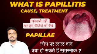 What is papillae Tongue papillitis cause treatment tonguepapillitis papillaeontongue imk [upl. by Noxin]