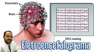 Eletroencefalograma EEG o que é tipos e para que serve o exame [upl. by Richara]