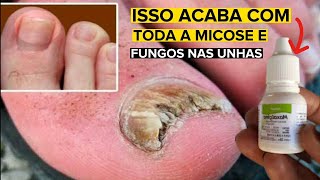 COMO CURAR MICOSE E FUNGOS NAS UNHAS com DIPIRONA [upl. by Oikim]