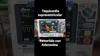 TAQUICARDIA SUPRAVENTRICULAR revertida con ADENOSINA [upl. by Caines808]