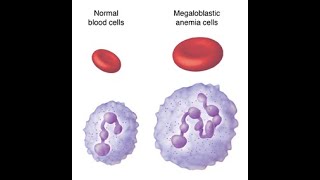 Megaloblastic anemia lecture April 2020 [upl. by Osrick]