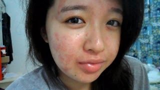 My Acne Story 15th Week of Accutane [upl. by Darnoc463]