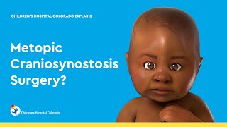 What is Metopic Craniosynostosis Surgery [upl. by Allebasi413]