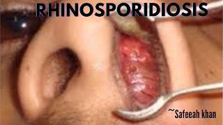 RHINOSPORIDIOSIS  Ent series Clinical features diagnosis and treatment [upl. by Notwal]