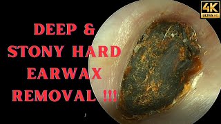 DEEP amp Stony HARD Earwax Removal Very Satisfying Video [upl. by Ellehcer540]