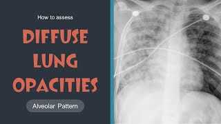 How to assess Diffuse Lung Opacities Alveolar Pattern Lec 14 [upl. by Edora342]