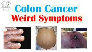 Colon Cancer Weird Symptoms amp Why They Occur [upl. by Myers]