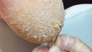 Super cracked sole repaired in time perfect【Pedicure Master Lin Jun】 [upl. by Atenek]