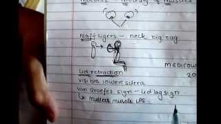 Thyroid eye signs mnemonic [upl. by Llenwad]