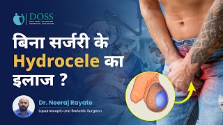 बिना सर्जरी के Hydrocele का इलाज  Hydrocele cure without surgery  Dr Neeraj Rayate Doss India [upl. by Magdalen306]