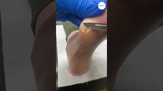 Callus formation on bunionette removed by podiatrist [upl. by Atinar225]