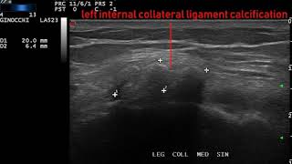 calcificazione del legamento collaterale interno sinistro [upl. by Kenzie]