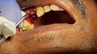 Extraction Of Upper Premolar Root Stumps Dr Sunil Kumar [upl. by Cherian]