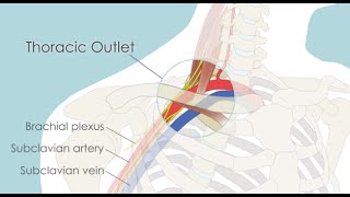 Transaxillary First Rib Resection for Thoracic Outlet Syndrome TOS [upl. by Hoyt]